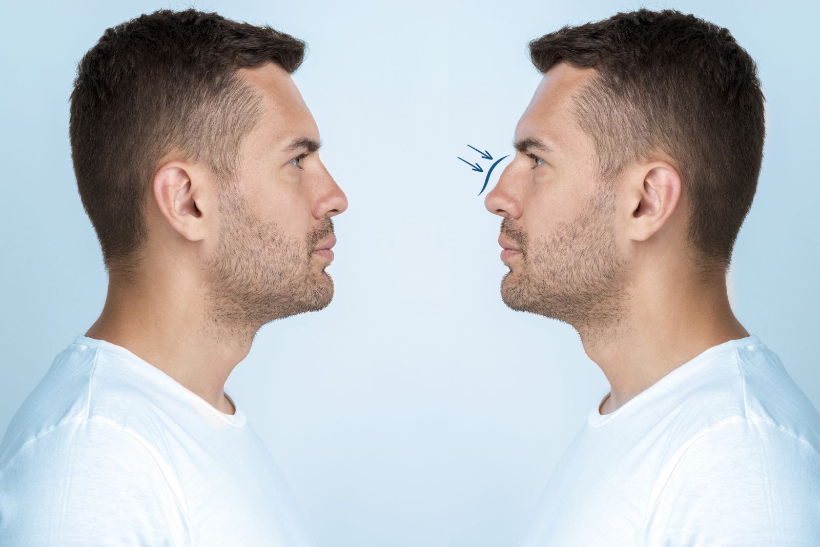 What is Rhinoplasty?